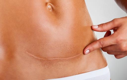 剖腹产的伤口该拿你怎么办 如何防止剖腹产疤痕增生-八福集