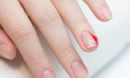 倒刺虽小处理不好会出大问题 预防倒刺有妙招-八福集