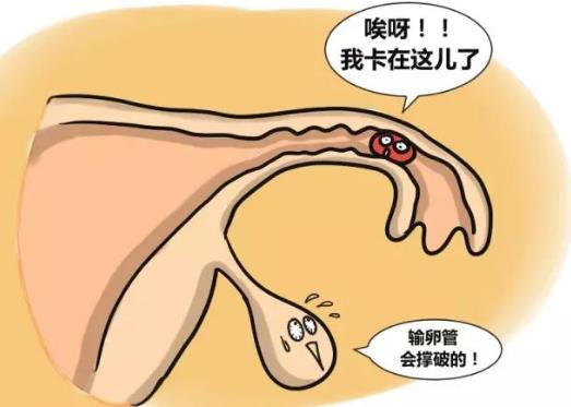 输卵管妊娠的自我检查、症状及治疗方法-八福集