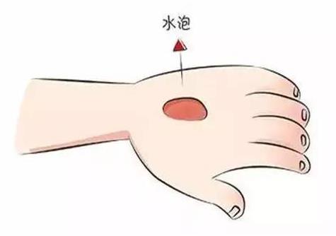 烫伤的水泡能挑破吗 科学处置烧烫伤方法-八福集