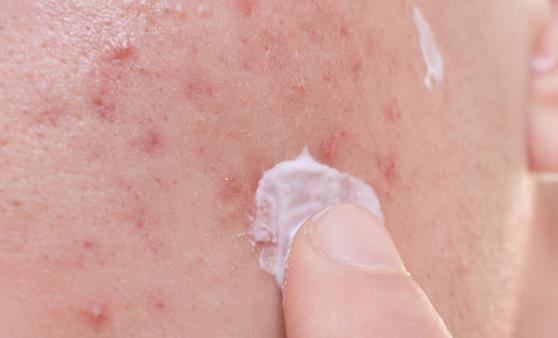 血热体质火气上升烦躁 调理血热多喝点菊花水-八福集