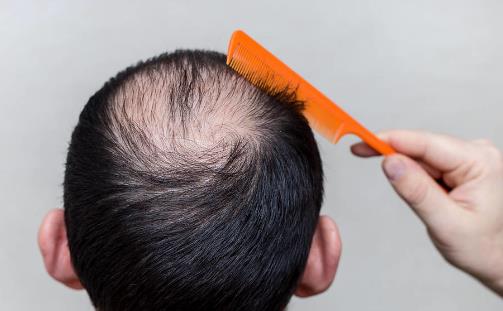 当代压力大脱发的人越来越多 冬日防秃的日常妙招-八福集