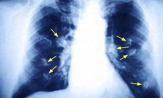 揪出引发女性肺癌的罪魁祸首 厨房油烟的危害超乎想象-八福集