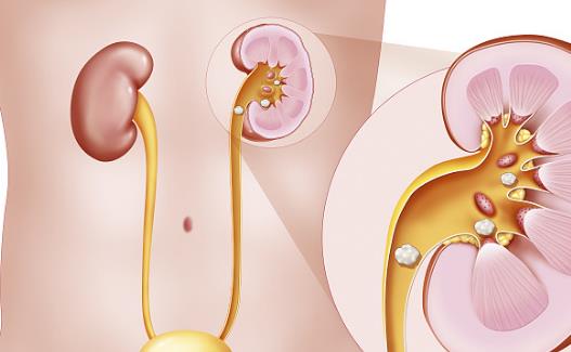 肾结石出现的六大原因 预防肾结石复发的饮食调理-八福集
