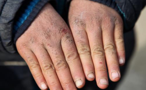 冬季长冻疮太难受 自制冻疮膏让你的双手恢复如初-八福集