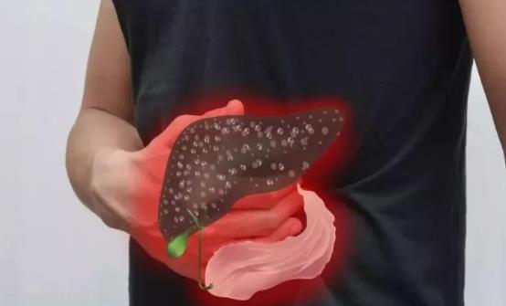 治疗黄疸型肝炎的9则小偏方 能有效治疗黄疸型肝炎-八福集