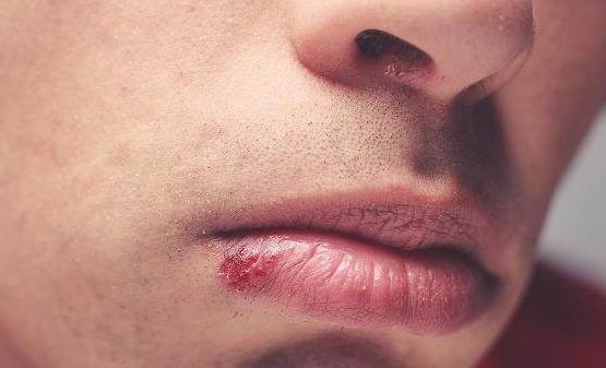 凛冬已至嘴唇总是干裂起皮发炎 冬天常见的嘴唇问题分析-八福集