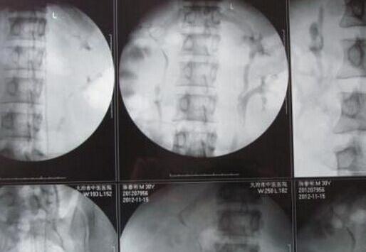 男子体内长四个肾,可以买肾6了
