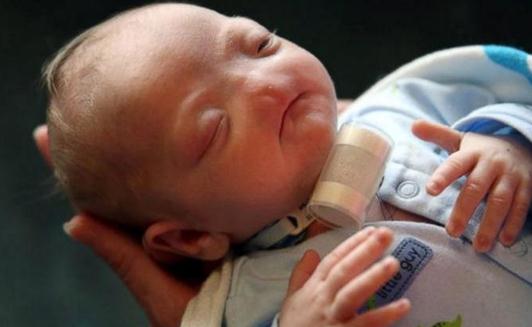 没有鼻子的婴儿,妈妈说他是完美的