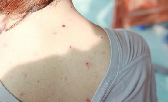 为什么后背容易长痘 可使你背部痘痘消散的小妙招-八福集