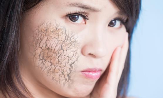 冬季皮肤干燥是怎么回事 皮肤干燥要怎么缓解-八福集
