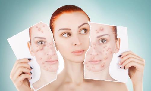 内分泌六项面部长痤疮 痤疮的食疗方推荐-八福集