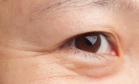 皮肤水分不足易导致眼角皱纹 常做眼部运动告别眼角皱纹-八福集