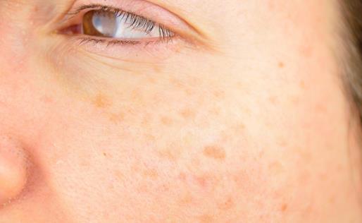 有效去除老年斑的方法小集锦 家庭单方去除老年斑-八福集