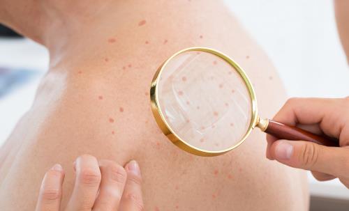 皮肤高度过敏也要学会保湿 皮肤高度过敏注意防晒-八福集