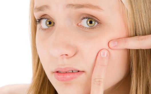 易生痘痘的人 去除痤疮产生的印记小妙招-八福集