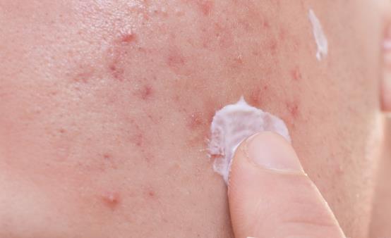 秋冬季节去除闭口粉刺有妙招 去除粉刺的食疗方推荐-八福集