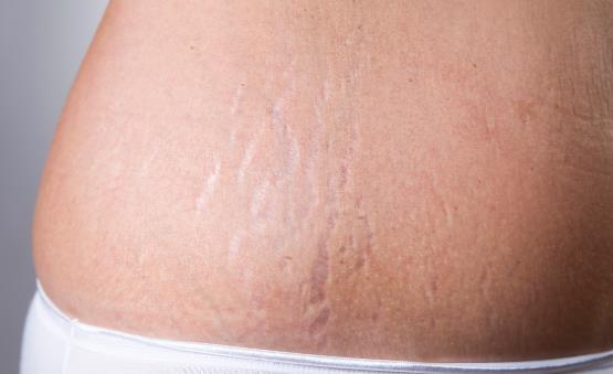 肥胖纹怎么消除 饮食合理规律作息肥胖纹也不再可怕-八福集