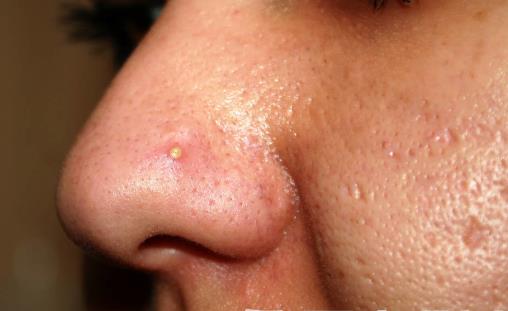 鼻子总是爱出油怎么办 脸部出油需要全面护理-八福集