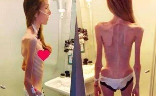 女孩1米8重30公斤 厌食症的危害-八福集